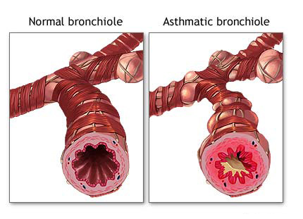 Bronhii normale vs bronhia pacientului cu astm